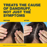 Nizoral® 2% Anti-Dandruff Shampoo, 100ml, Medical Treatment with Ketoconazole, Clinically Proven to Treat Dandruff, Flakes & Itching
